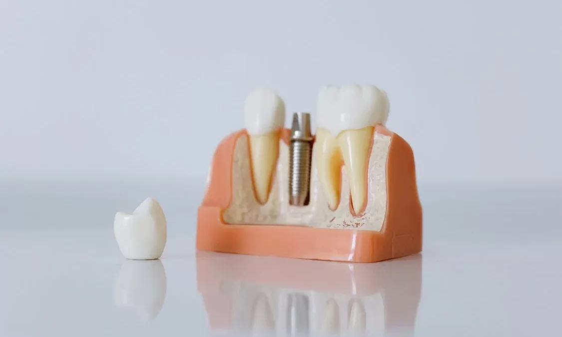 Tipuri de implanturi dentare și caracteristicile acestora